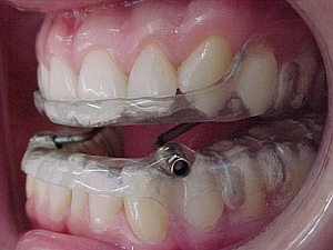 USO DE APARELHOS ORAIS PARA O TRATAMENTO DA APNEIA DO SONO: FA�A O DOWNLOAD